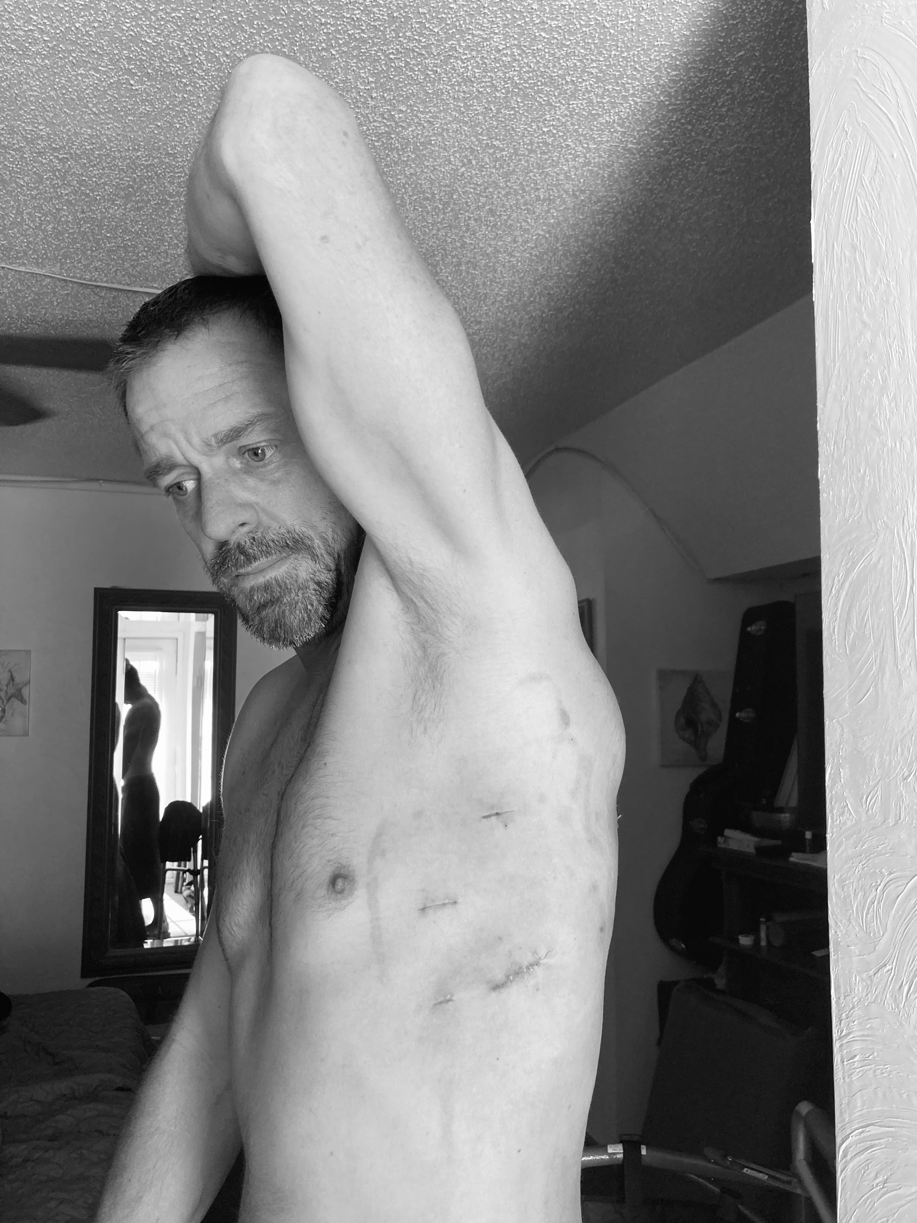 Surgical scars on Michael Cavett's body