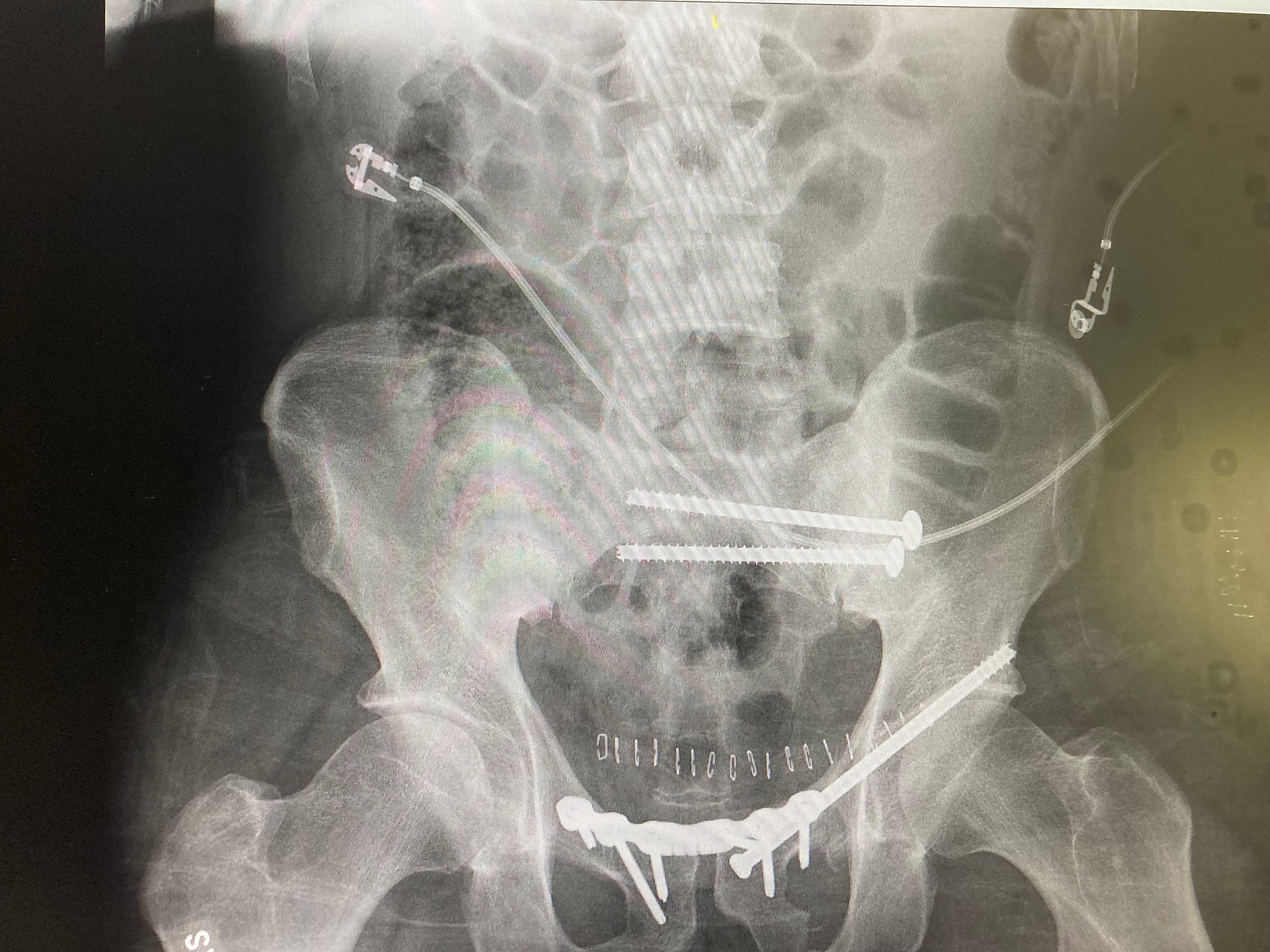 X-ray of surgical hardware in Michael Cavett's pelvis