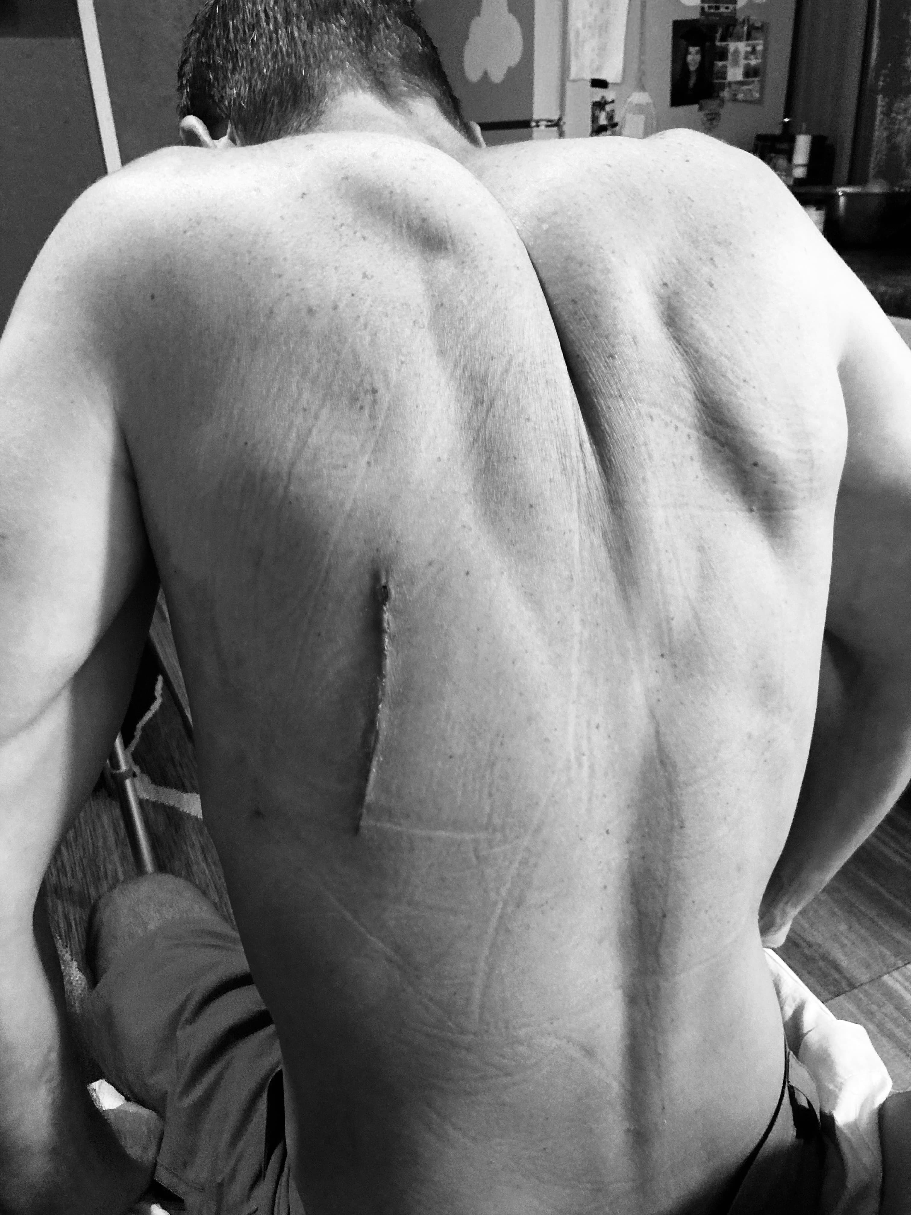 Surgical scar on Michael Cavett's back